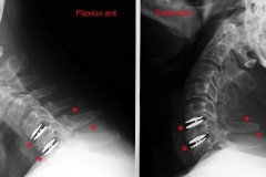 Prothèses discales cervicales RX dynamiques à 6 mois