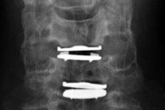 prothèses discales cervicales RX face