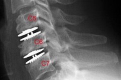 Prothèses discales cervicales RX profil