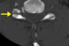 fracture séparation massif articulaire (FSMA) luxée C5C6