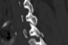 fracture séparation massif articulaire (FSMA) luxée C5C6