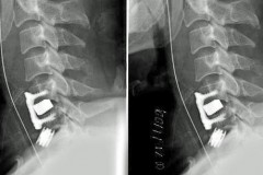 fracture séparation massif articulaire (FSMA) luxée C5C6