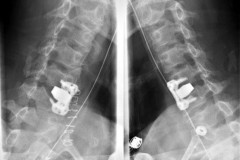 fracture séparation massif articulaire (FSMA) luxée C5C6