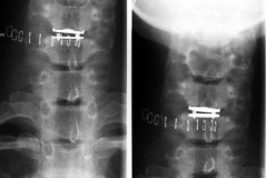 prothèse cervicale Mobi C C5C6