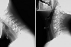prothèse cervicale Mobi C C5C6