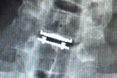 colonne-cervicale-prothese-mobi-c-c5c6-14-mois-inclinaison-gauche