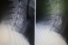 Hernie discale avec arthrodèse en C5C6