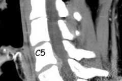 hernie discale cervicale c5c6