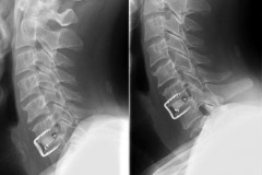 hernie discale cervicale C6C7 avec arthrodèse