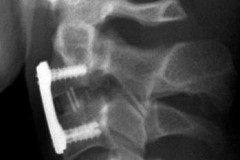 fracture de la 2ème vertèbre cervicale