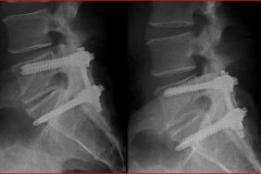 arthrodese L5S1 17 ans