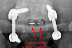 arthrodèse intersomatique à 1 an