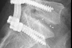 arthrodèse intersomatique à 1 an