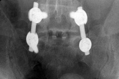 arthrodèse L5S1 ET MOBILITE