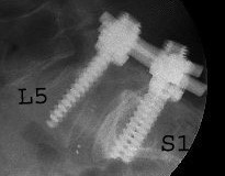 arthrodèse L5S1 pour SPL grade 1