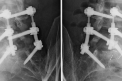 arthrodèse rigide L5S1 et système semi-rigide flexplus en L4L5