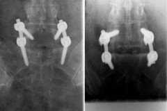 rx face 5 mois Po arthrodèse L5S1 avec cages et vis