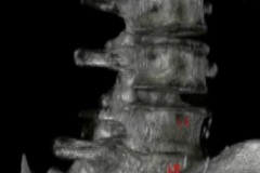 spondylolisthesis grade 2 et discarthrose L4L5 sévère