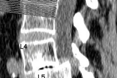 spondylolisthesis grade 2 et discarthrose L4L5 sévère