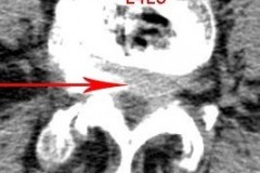 spondylolisthesis sévère grade 2 dégénératif et discarthrose L4L5