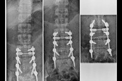 arthrodèse L3S1 postérieure