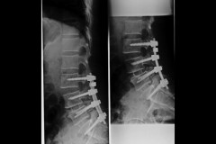 arthrodèse L3S1 postérieure