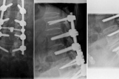 CLE de L2 à S1 + arthrodèse