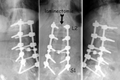 laminectomie + arthrodèse L2 à S1 pour CLE