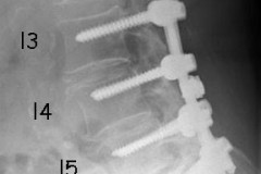 laminectomie + arthrodèse l2 à s1 pour CLE