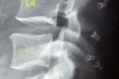 recalibrage lombaire L3 à S1 + 3 DIAM