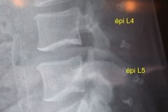 recalibrage lombaire L3 à S1 + 3 DIAM