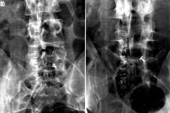 RX face post op recalibrage L5S1 avec D.I.A.M