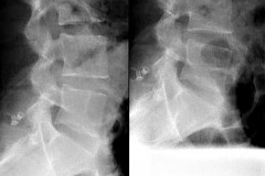 RX profil post op recalibrage L5S1 avec D.I.A.M