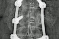 Burst fracture de L2 RX post op face