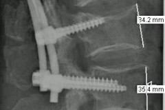 Burst fracture de L2 RX post op profil