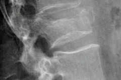 burst fracture de l2