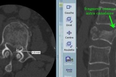 burst fracture de L2