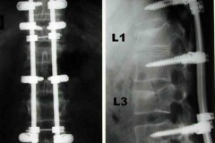 fracture L1 et L3 + paraplégie