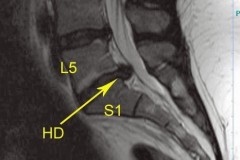 hernie discale l5s1 gauche
