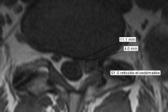 IRM d'une hernie discale L5S1 gauche