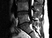 IRM d'une hernie discale L5S1