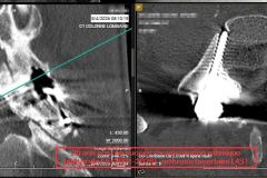 25-post-op-CT-reconstitution-isthmique-2001-2026