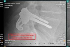 25-post-op-RX-succes-reconstitution-isthmique-2001-2026