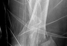 autre fracture comminutive distale du fémur