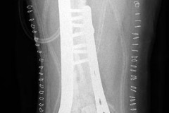 reconstruction par double plaque et allogreffe