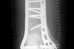 reconstruction par double plaque et greffe