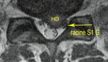 hernie-discale-l5s1-gauche